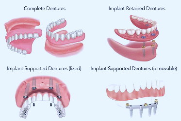Frequently Asked Questions About Dental Implants and Implant Supported  Dentures